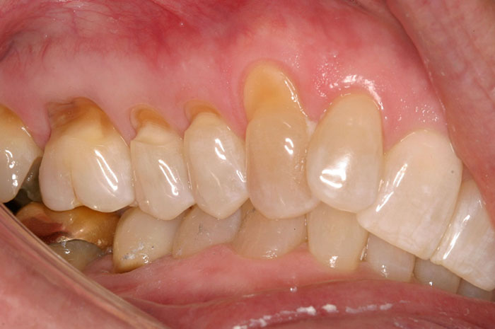 جرمگیری و دغدغه‌ی آسیب به مینای دندان