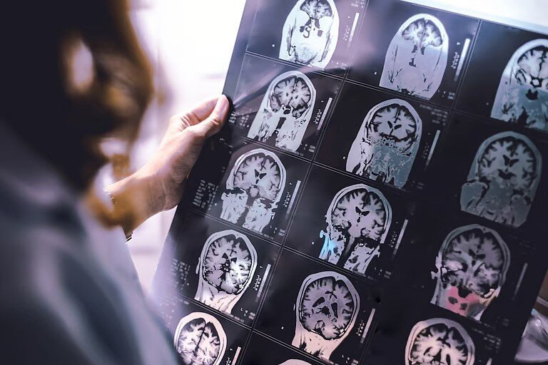 علائم ام‌اس ۱۵سال جلوتر بروز می‌کند